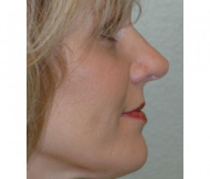 Nose Reshaping