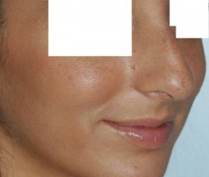 Nose Reshaping