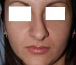 Nose Reshaping