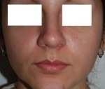 Nose Reshaping