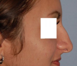 Nose Reshaping