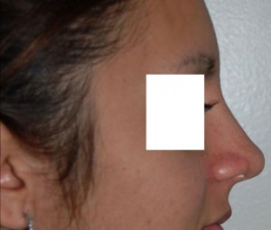 Nose Reshaping