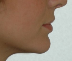 Chin Enhancement