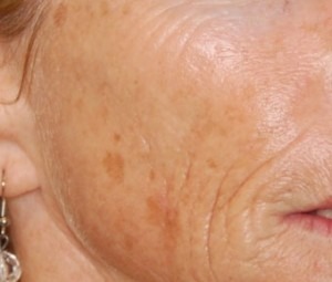 Laser Skin Peel