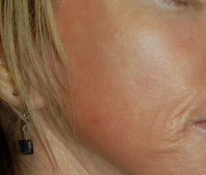 Laser Skin Peel