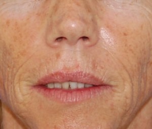 Laser Skin Peel