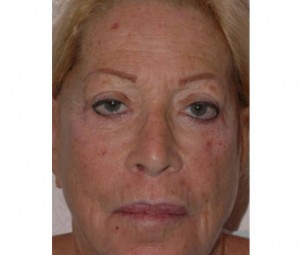 Laser Skin Peel