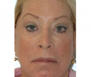 Laser Skin Peel