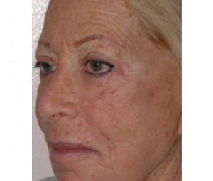 Laser Skin Peel