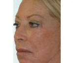 Laser Skin Peel