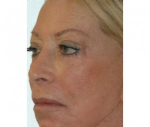 Laser Skin Peel