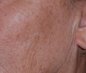 Laser Skin Peel