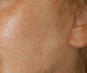 Laser Skin Peel