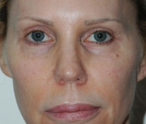 Natural Facial Filler