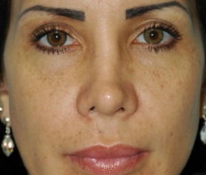 Natural Facial Filler