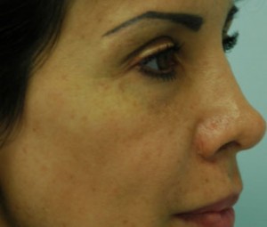 Natural Facial Filler