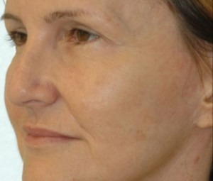 Natural Facial Filler