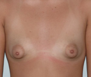 Breast Augmentation