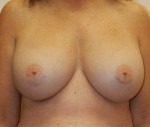 Breast Augmentation