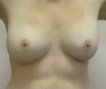 Breast Augmentation