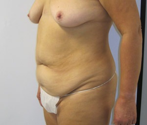 Liposuction