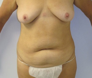 Liposuction