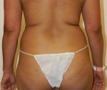 Liposuction