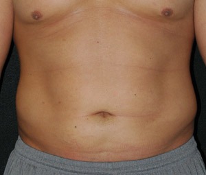 Liposuction