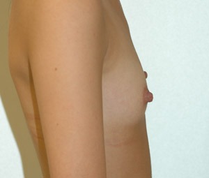 Breast Augmentation