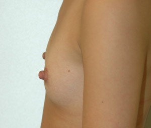 Breast Augmentation