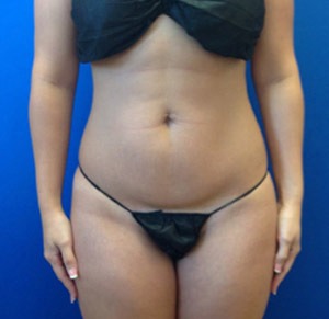 Liposuction