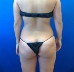 Liposuction