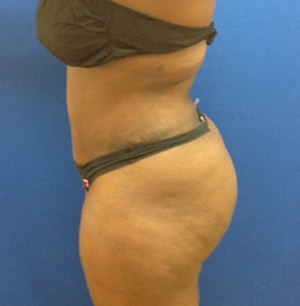 Liposuction