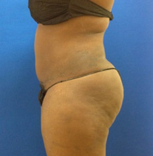 Liposuction