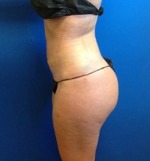 Liposuction