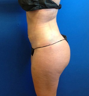 Liposuction