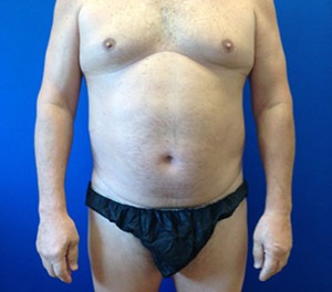 Liposuction