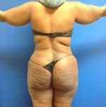 Liposuction