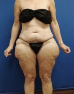 Liposuction