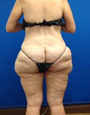 Liposuction