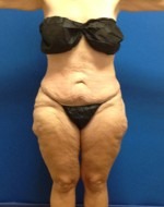 Liposuction