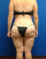 Liposuction