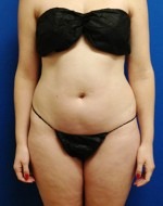 Liposuction