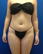 Liposuction