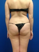 Liposuction
