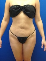 Liposuction