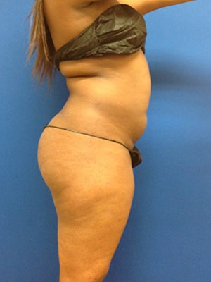 Liposuction