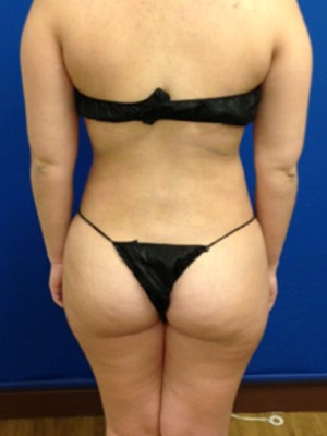 Liposuction