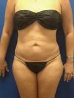 Liposuction