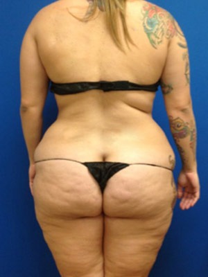 Liposuction